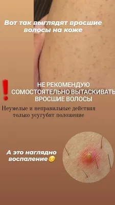 Пустулезный псориаз: виды лечения - Vitimed