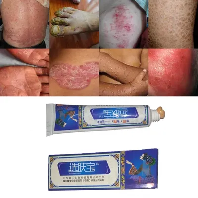 https://www.gosmed.ru/lechebnaya-deyatelnost/spravochnik-zabolevaniy/dermatovenerologiya-bolezny/psoriaz/