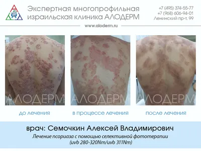Эффективное лечение псориаза методом фототерапии в Москве | Клиника АЛОДЕРМ  , Москва