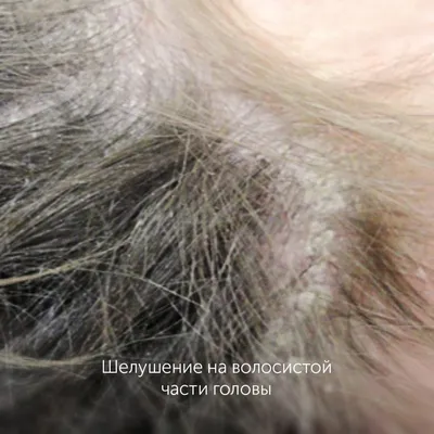 Мазь LEO Дайвонекс (от псориаза) - «3 года мучений с псориазом волосистой  части головы, и стойкая ремиссия за два месяца!» | отзывы