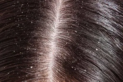 Псориаз волосистой части головы: средства и методы лечения и ухода