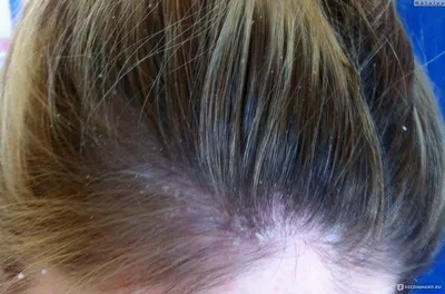 Псориаз на голове - как и чем лечить болезнь волосистой части кожи, как он  выглядит, лучшие средства для лечения симптомов, фото