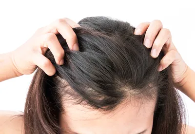 Псориаз волосистой части головы - лечение псориаза, консультация и цены в  Одессе и Украине