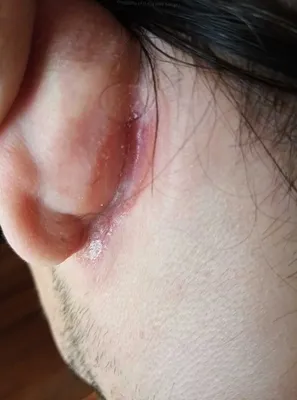 Мокнущие трещины за ушами: причины, лечение и профилактика