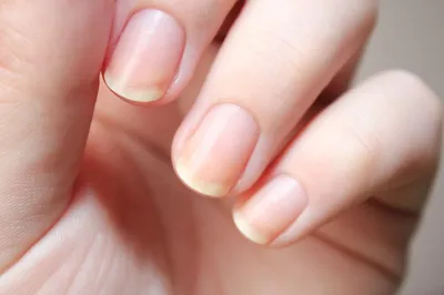 Птеригий на ногтях: проблема и способы избавиться