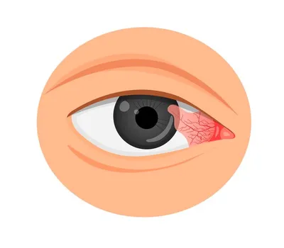 Офтальмохирург Мария Попова on Instagram: \"Птеригиум — это патологический  процесс, при котором поверхность роговицы глаза зарастает тканями  конъюнктивы, чего в норме быть не должно. Есть несколько степеней птеригиума.  Если он не выраженный,