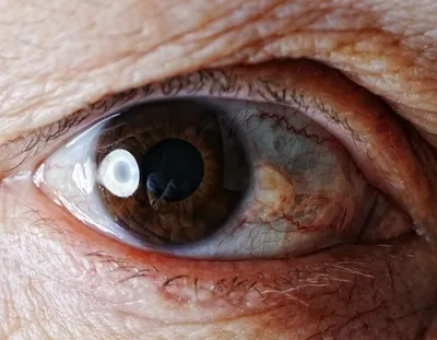 Клиника \"Новый Взгляд\" - Птеригиум, или крыловидная плева – это нарост на  конъюнктиве, который со временем прорастает в роговицу. Наиболее часто  встречается у пожилых людей. ⠀ Внешне птеригиум глаза выглядит как  непрозрачная