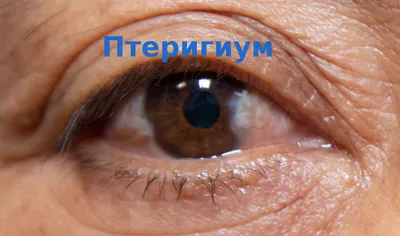 Что это такое птеригиум глаза... - ЧОРИКУЛ ШАЙМАТОВ ГАВХАРИ | Facebook