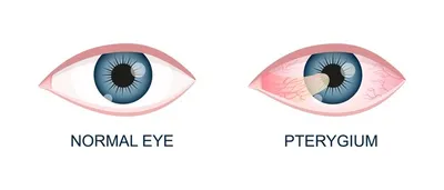 Лечение птеригиума в Минске | Лазерная коррекция зрения - Удаление  катаракты в Минске - Центр микрохирургии глаза VOKA