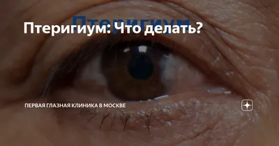 Глазная клиника Федоровой Ирины Святославны - Птеригиум (крыловидная плева)  представляет собой нарастание конъюнктивы на роговицу, прозрачную часть  глаза, через которую лучи света попадают внутрь. Чаще встречается со  стороны носа, может поражать как