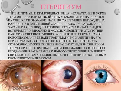 ОФТАЛЬМОЛОГИЧЕСКИЙ ЦЕНТР on Instagram: \"👁️ Птеригиум. Что это такое? 🔴 Птеригиум – это термин, который происходит от греческого слова, в переводе  обозначающего крыло. При этом заболевании на роговицу глаза нарастает  фиброзная ткань, которая