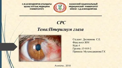 Лечение птеригиума – Глазная клиника Фёдоровой Ирины Святославны – Центр ФИС