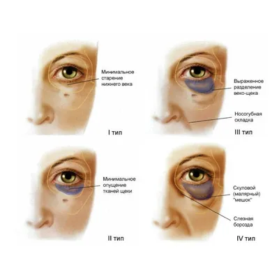 Гравитационный птоз лица - что это такое: фото опущения — VICLINICS