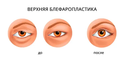 Бигельдиев Ришат Калилуллаевич - ПТОЗ верхнего века. Данную пациентку уже  оперировали 4 раза. 1 операцию в детстве (подшитие к бровной дуге) Затем  две операции в КЗ, когда она была уже взрослая. 4