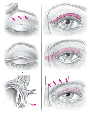 Неполный птоз верхнего века - энциклопедия Ochkov.net