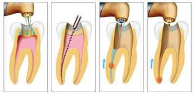 Пульпит: острый и хронический. Лечение пульпита в Санкт-Петербурге