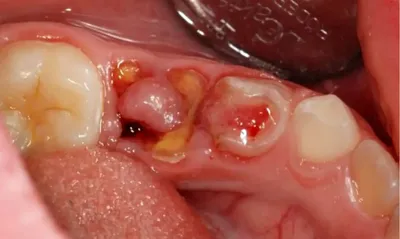 Лечение пульпита с пломбированием корневых каналов зуба - детская  стомалогия Nikadent Family