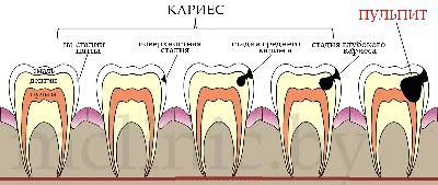 Пульпит и его лечение - стоматология Мастер клиник в г.Бресте