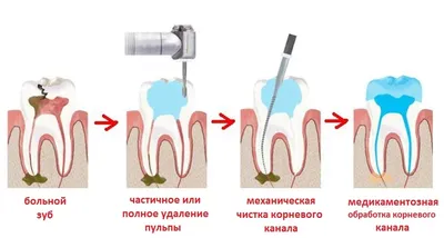 Лечение пульпита зуба в Москве. Профилактика, цена, симптомы и причины.