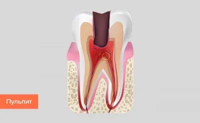 Лечение пульпитов - Стоматологическая клиника Demokrat в Тюмени