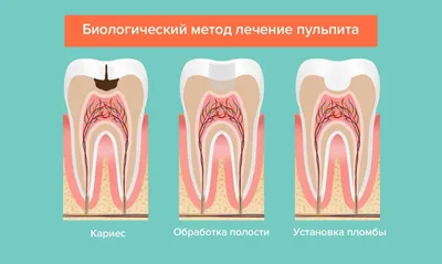 Лечение от пульпита