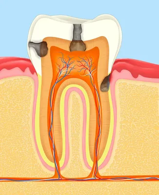 Лечение пульпита - симптомы и лечение, цена – удаление пульпы у взрослых и  детей