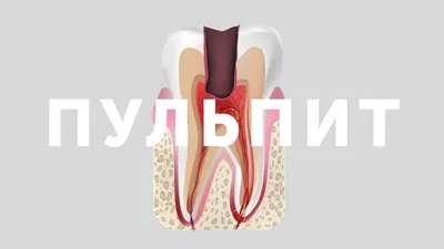 Что такое пульпит зуба? Как лечить и как не допустить? - Эфимед