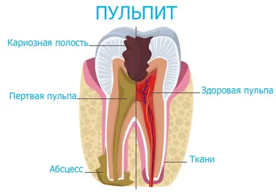 Пульпит: симптомы и лечение | Центр стоматологии «Ваш Стоматолог»