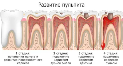 Пульпит - причины, симптомы, лечение в стоматологической клинике | Нава