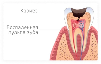 Лечение пульпита зуба в Брянске — цена в «Современная стоматология»