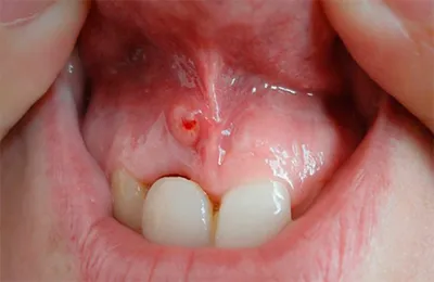 Пульпит зуба: лечение, симптомы, цены на лечение каналов в стоматологии —  ROOTT