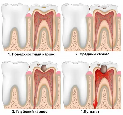 Лечение пульпита трехканального зуба в Москве: цена лечения в сети  стоматологий OneDent