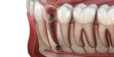 Гангренозный пульпит зуба - симптомы, диагностика, лечение