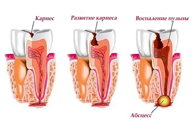 Лечение пульпита зуба в Москве [цены, симптомы и этапы лечения]