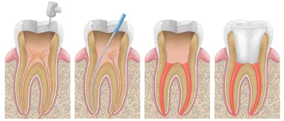 Диффузный пульпит - причины, симптомы, признаки, диагностика, лечение