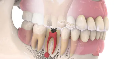 Хронический гипертрофический пульпит, симптомы гипертрофического пульпита  зубов