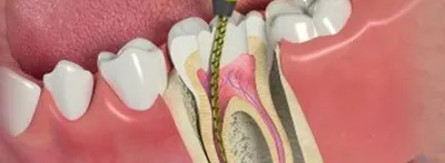 Пульпит зуба: симптомы и как его лечат