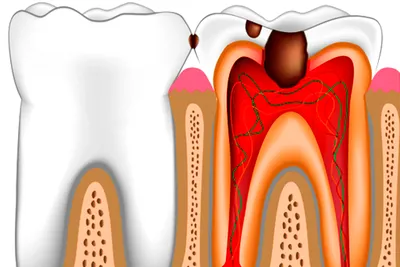 Лечение пульпита в Санкт-Петербурге - цены в клиниках «Бюджетная  стоматология»