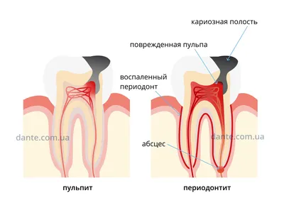 Острый пульпит: симптомы, диагностика, лечение | 3DMedica