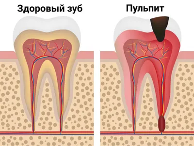 Воспаление зубного нерва【причины, симптомы и лечение】