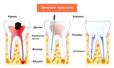 Лечение пульпита - профессиональное лечение зубов в стоматологии доктора  Фролова