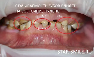Лечение пульпита в Омске. Удаление нерва зуба. Цены на лечение пульпита в  2023 году в стоматологии АлексДент