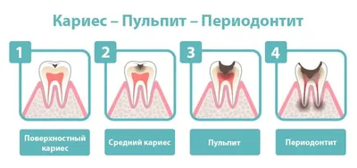 Травматический пульпит — виды, диагностика, лечение на Startsmile.ru