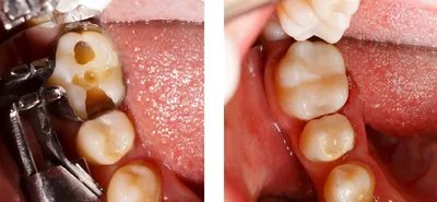 Лечение пульпита в Сочи, цены в стоматологии Аврора