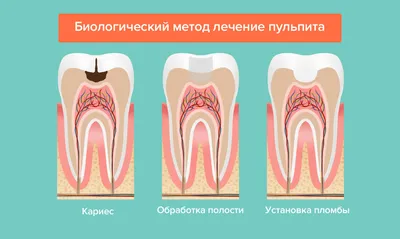 Лечение пульпита молочных зубов в Запорожье: цены, отзывы | Детская  стоматология ГАММА