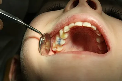 Лечение пульпита - МегаДент - стоматология в Красноярске