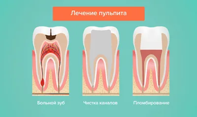Пульпит молочных и постоянных зубов у детей — Стоматология «Доктор НеболитЪ»