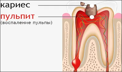 Лечение пульпита - МегаДент - стоматология в Красноярске
