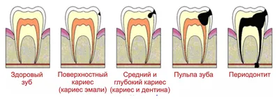 Лечение пульпита молочных зубов у детей – стоимость в Некрасовке |  Стоматологическая клиника «Alident»