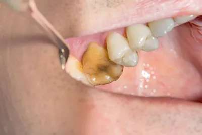 Лечение пульпита молочных зубов | Стоматология на Гагарина